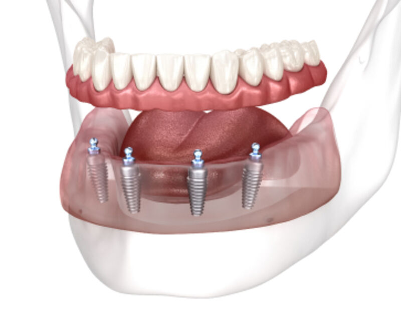 All-on-4 full arch video