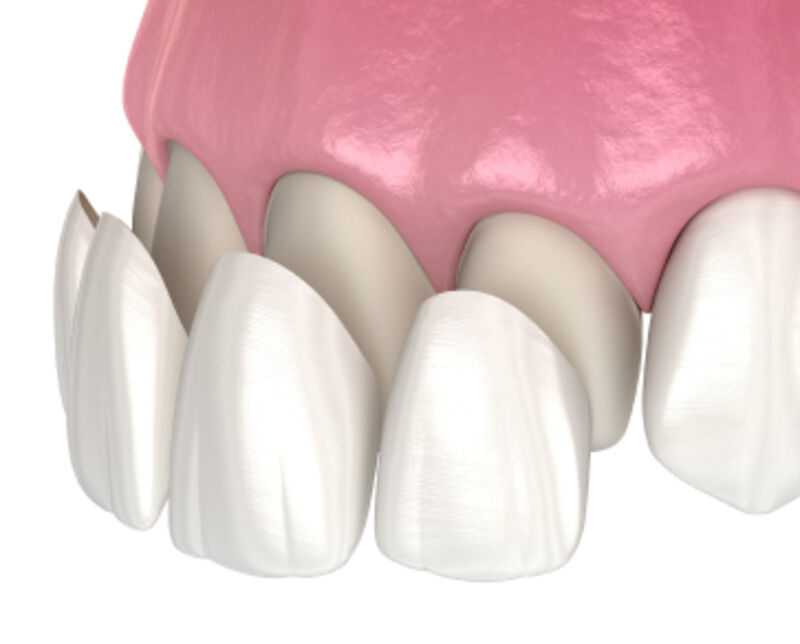 Dental veneers video